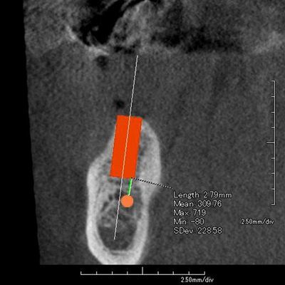 インプラントオペCT2015.03.04 01R84-thumb-400x400-32513.jpg