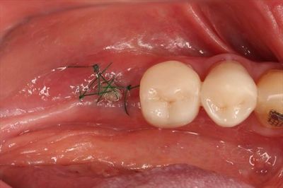 インプラント撤去し，サイトプラストによる封鎖後5日が経ちました