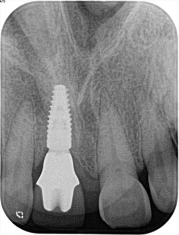 前歯のジルコニアカスタムアバットメントのレントゲン写真
