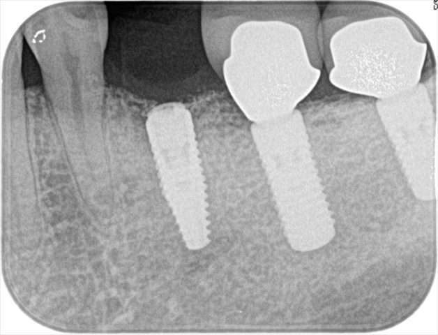 左下第二小臼歯インプラント埋入後レントゲン