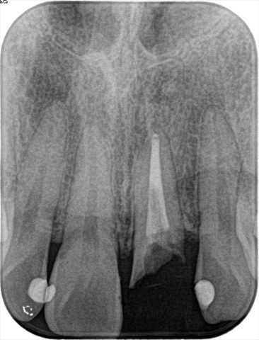 破折して折れて朽ちている左上中切歯（左上1）のデンタルレントゲン写真