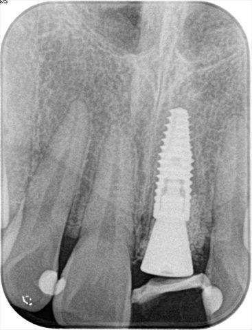 左上中切歯の抜歯即時インプラント埋入オペを行いヒーリングキャップを装着し撮影したデンタルレントゲン写真