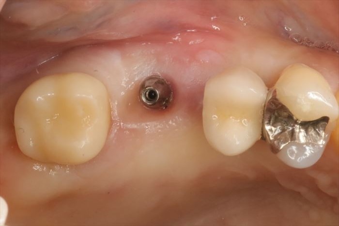 インプラントの撤去 アンキロスインプラントの撤去＆埋入手術を行いました。2025.09.24