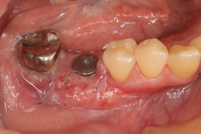 右下第一大臼歯頬側部分に遊離歯肉移植術(FGG:Free Gingival Graft)後、8日経過した状態の写真