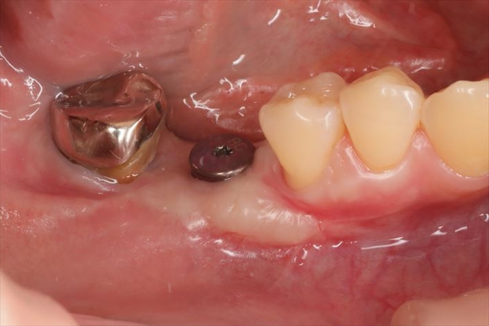 右下第一大臼歯頬側に遊離歯肉移植術(FGG:Free Gingival Graft)後、約1か月経過した状態の写真