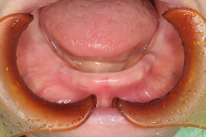 下顎無歯顎の写真